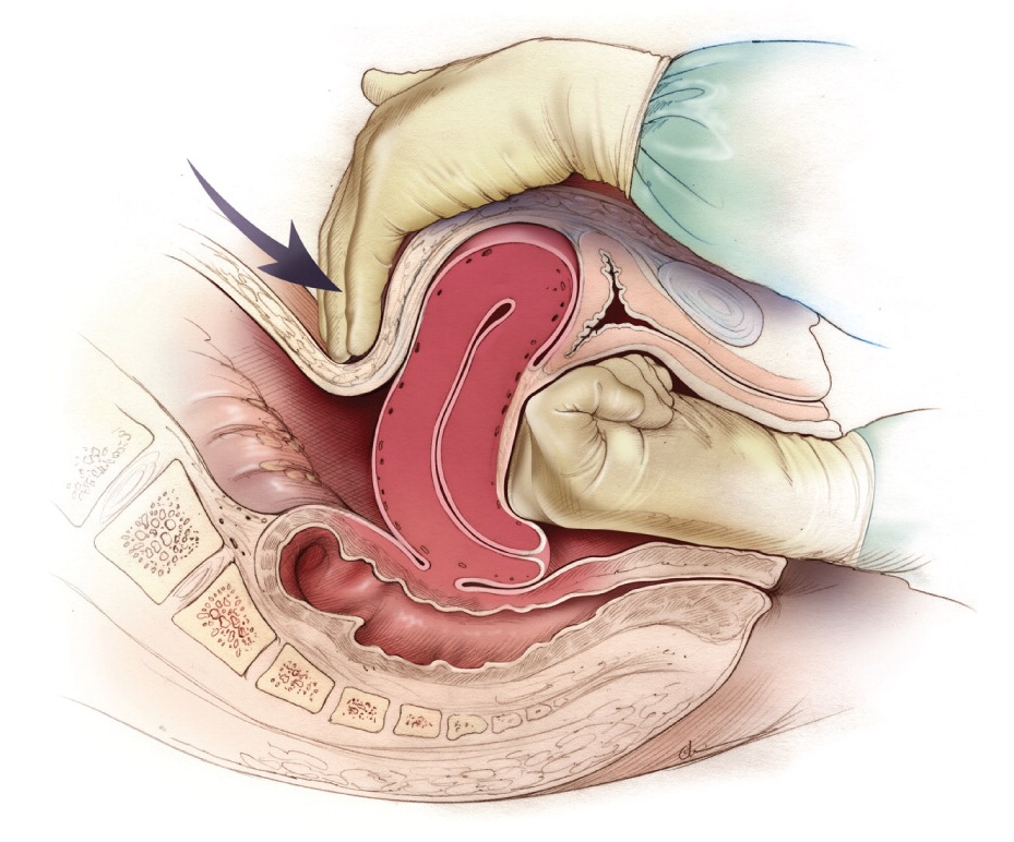 Oxytocin for uterine atony